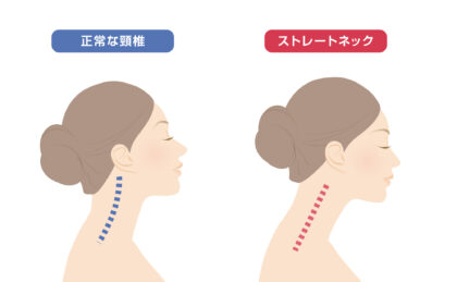 ストレートネック