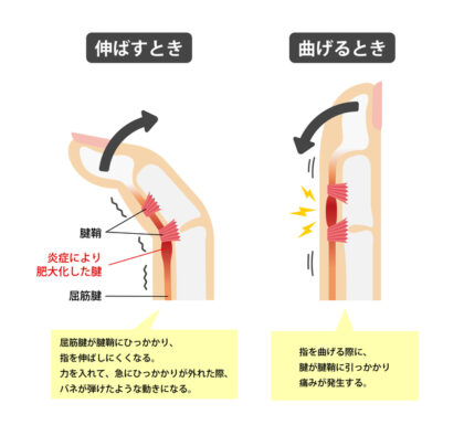 ばね指（弾発指）