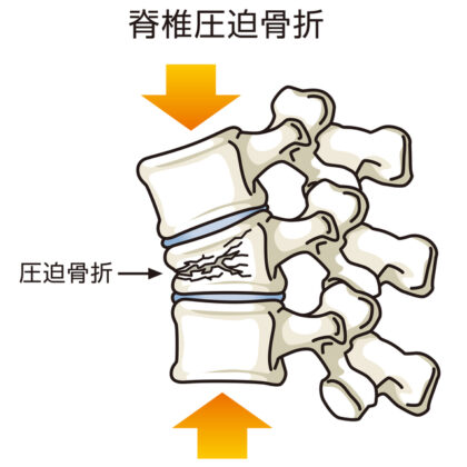 脊椎圧迫骨折