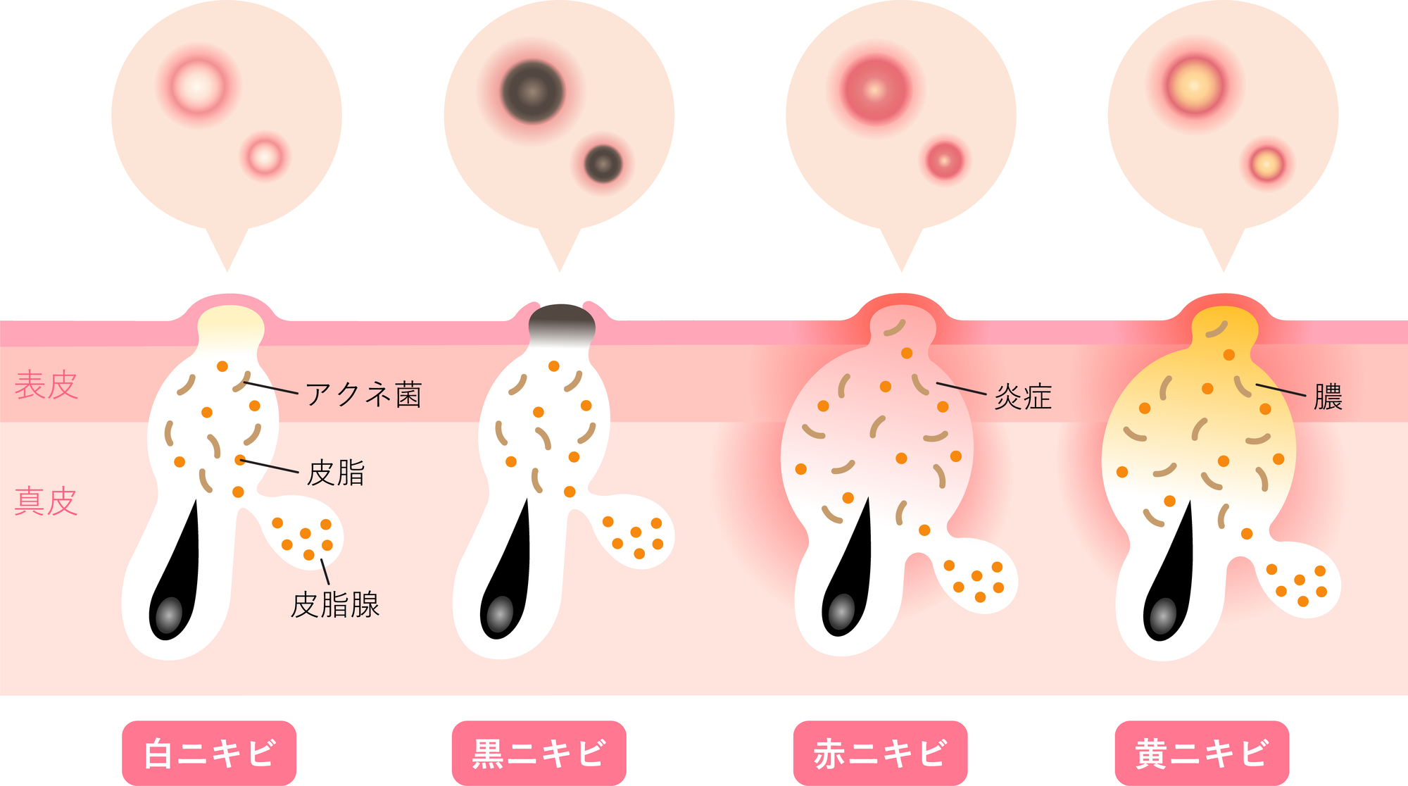ニキビの種類と症状、対処法について