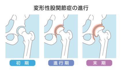 変形性股関節症