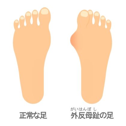 外反母趾・扁平足