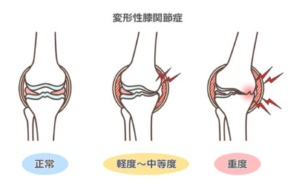変形性膝関節症