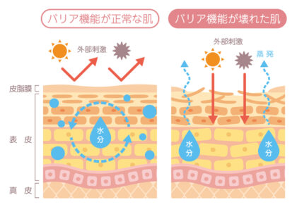 アトピー性皮膚炎の原因