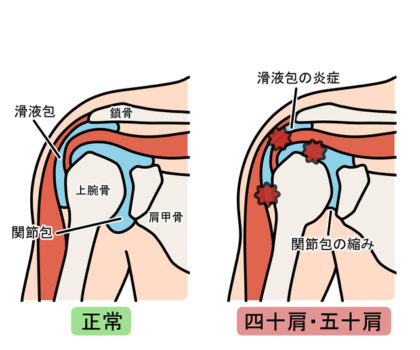 急性期